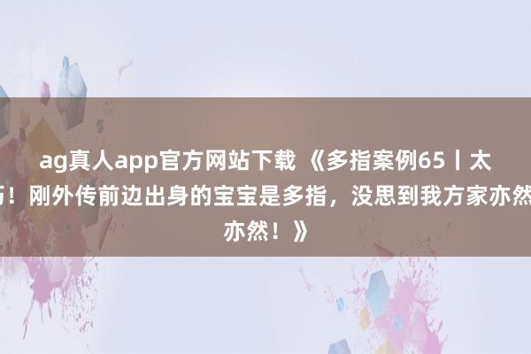 ag真人app官方网站下载 《多指案例65丨太正巧！刚外传前边出身的宝宝是多指，没思到我方家亦然！》